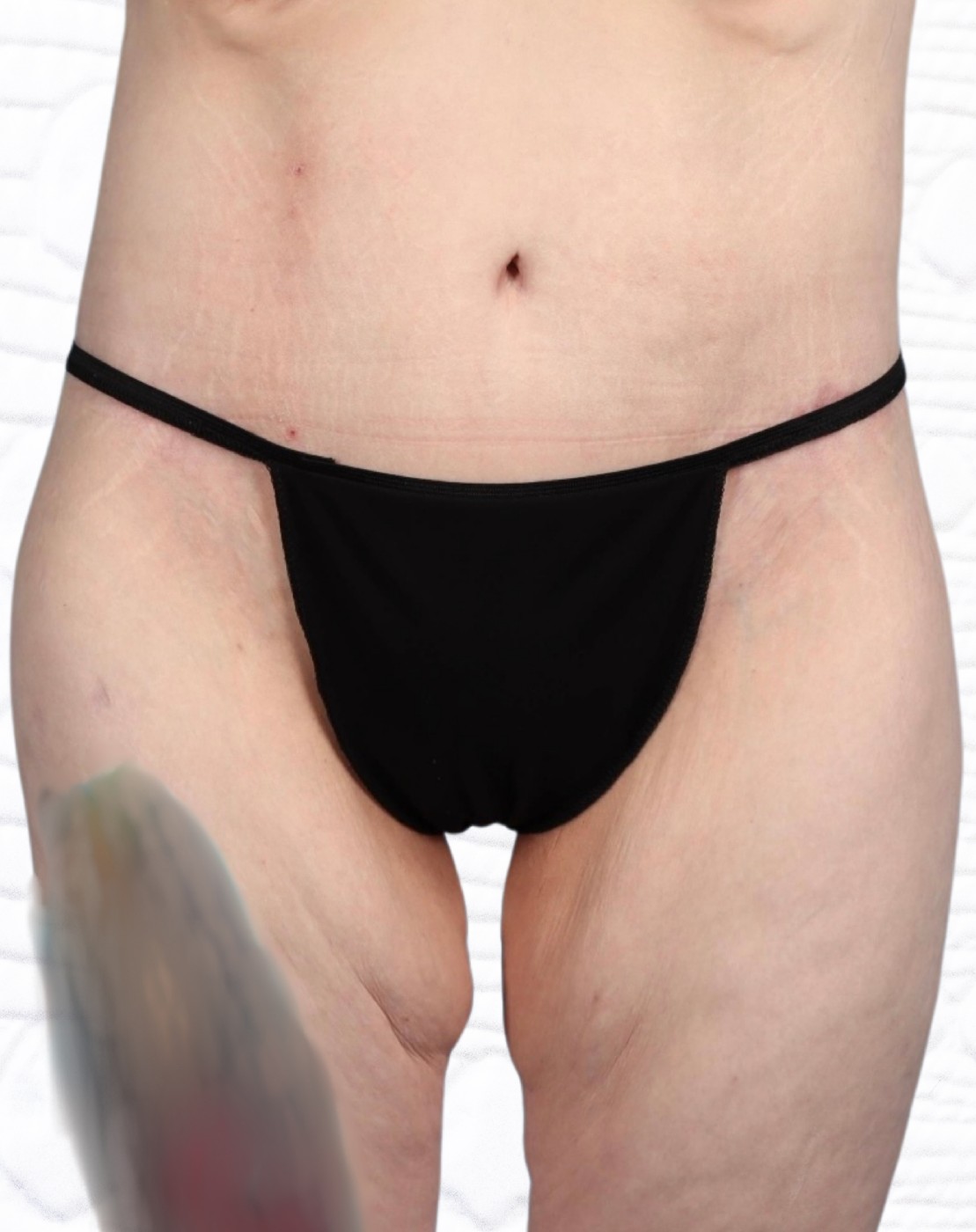 Lower Body Lift Before & After Image