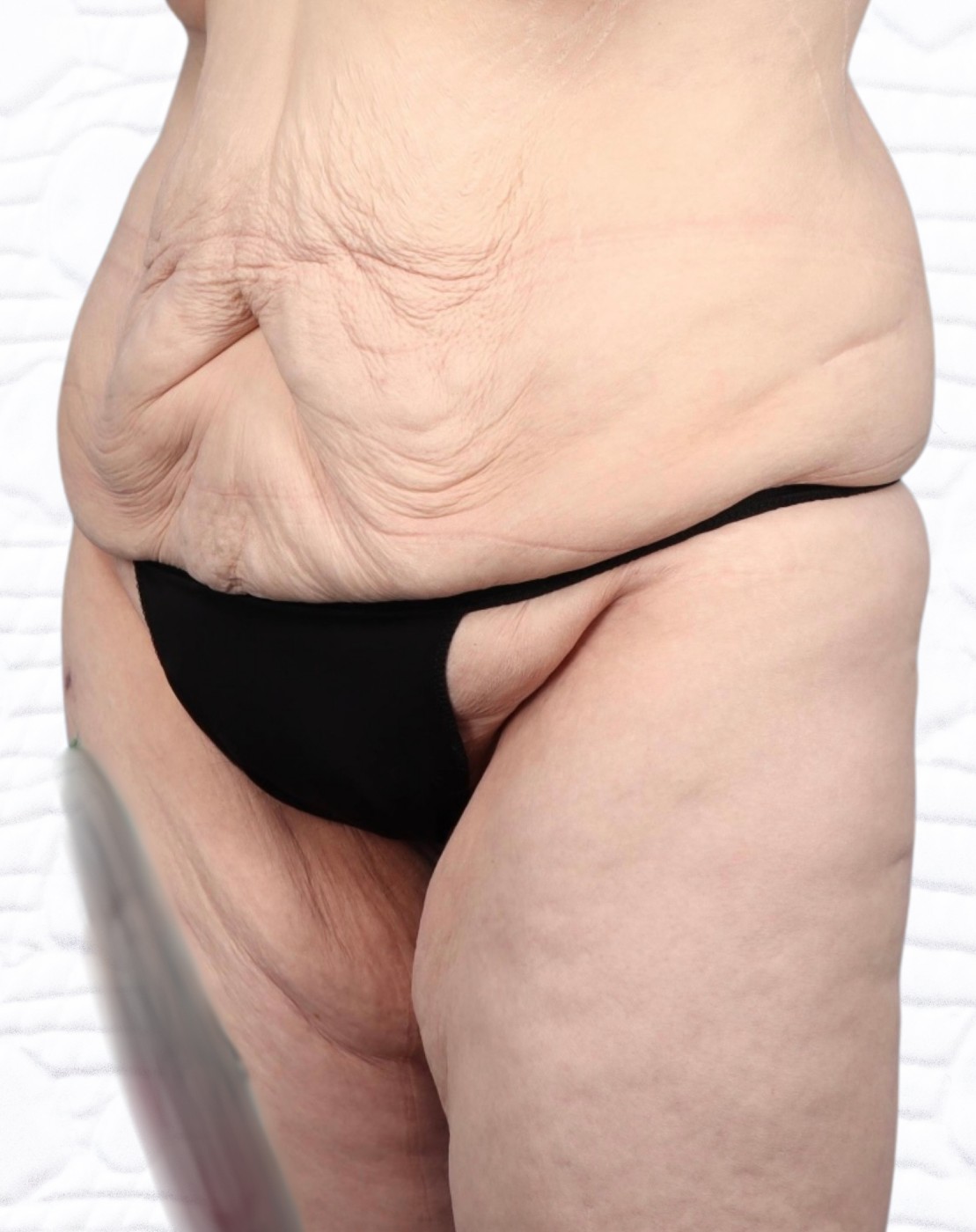 Lower Body Lift Before & After Image