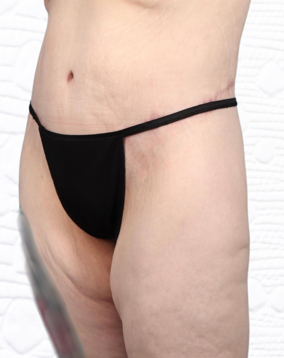 Lower Body Lift Before & After Image
