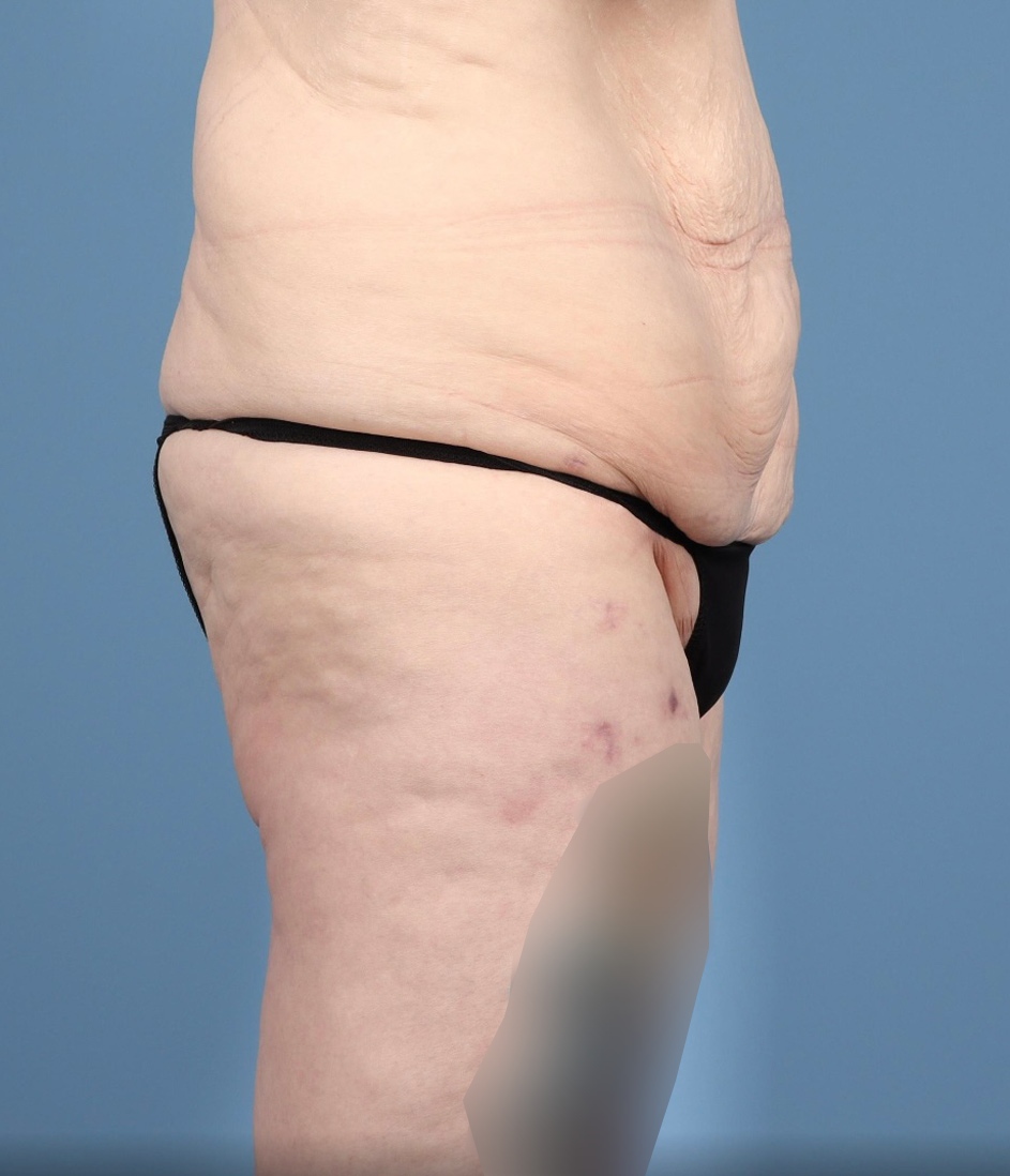 Lower Body Lift Before & After Image