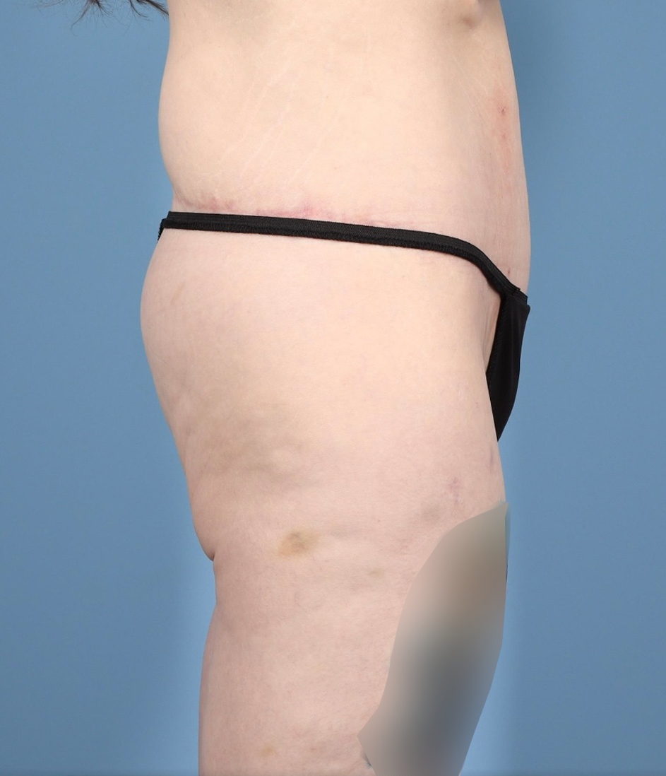 Lower Body Lift Before & After Image