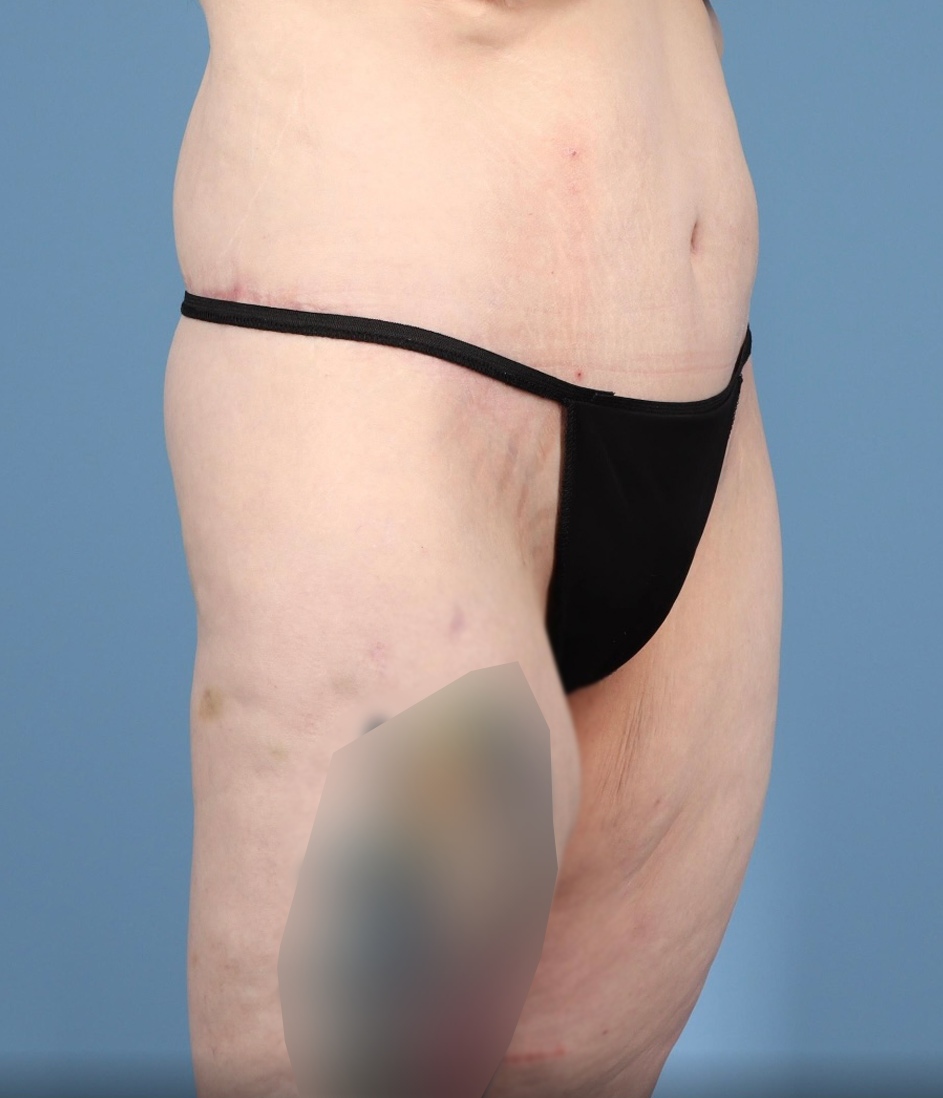 Lower Body Lift Before & After Image