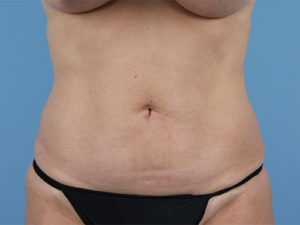 Tummy Tuck Before & After Image