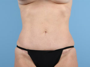 Tummy Tuck Before & After Image