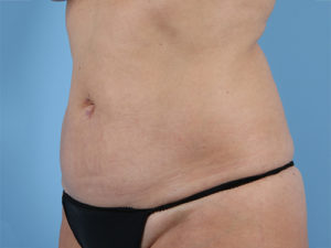 Tummy Tuck Before & After Image