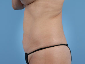 Tummy Tuck Before & After Image