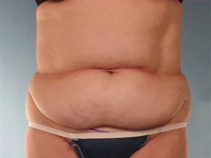 Tummy Tuck Before & After Image