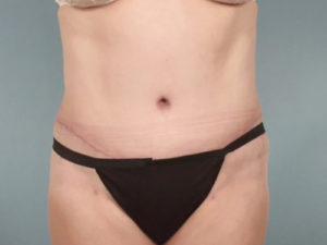 Tummy Tuck Before & After Image