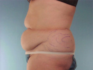 Tummy Tuck Before & After Image