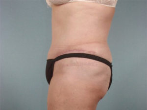 Tummy Tuck Before & After Image