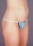 Tummy Tuck Before & After Image