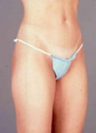 Tummy Tuck Before & After Image