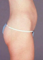 Tummy Tuck Before & After Image