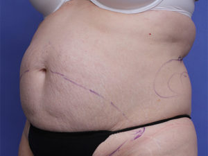 Tummy Tuck Before & After Image