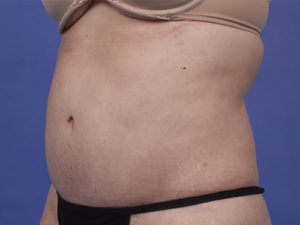 Tummy Tuck Before & After Image