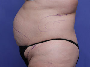 Tummy Tuck Before & After Image