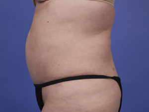 Tummy Tuck Before & After Image