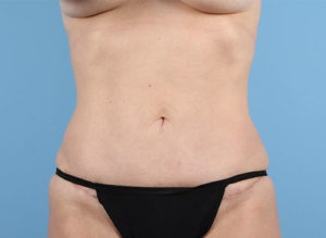 Tummy Tuck Before & After Image