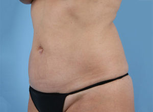 Tummy Tuck Before & After Image