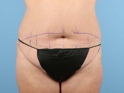 Tummy Tuck Before & After Image