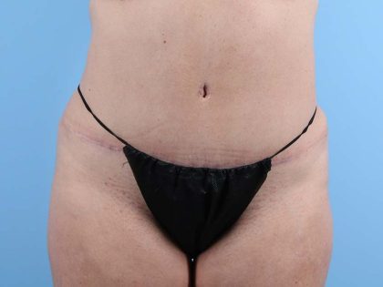 Tummy Tuck Before & After Image