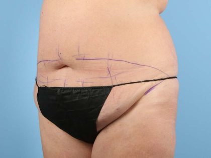 Tummy Tuck Before & After Image