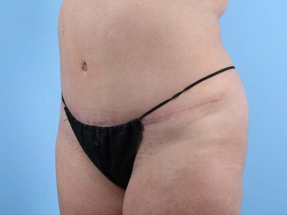 Tummy Tuck Before & After Image