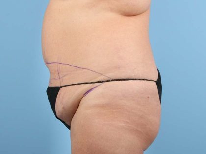 Tummy Tuck Before & After Image