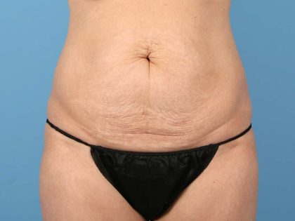 Tummy Tuck Before & After Image