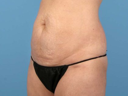 Tummy Tuck Before & After Image