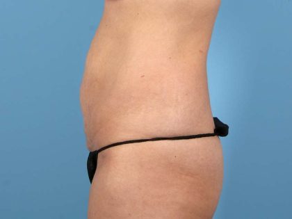 Tummy Tuck Before & After Image