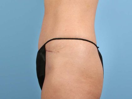 Tummy Tuck Before & After Image