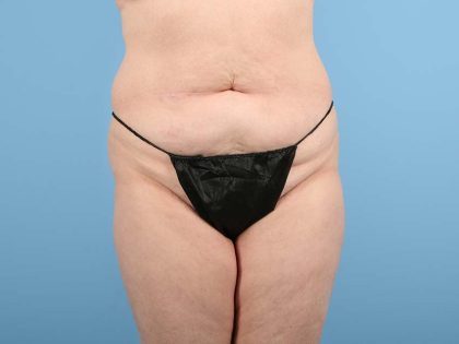 Tummy Tuck Before & After Image