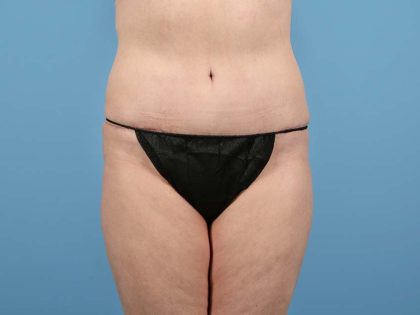 Tummy Tuck Before & After Image