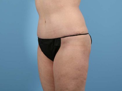 Tummy Tuck Before & After Image