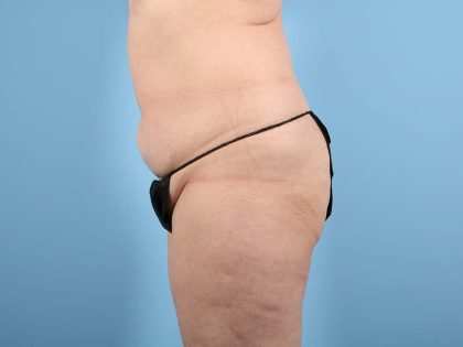 Tummy Tuck Before & After Image