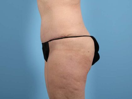 Tummy Tuck Before & After Image