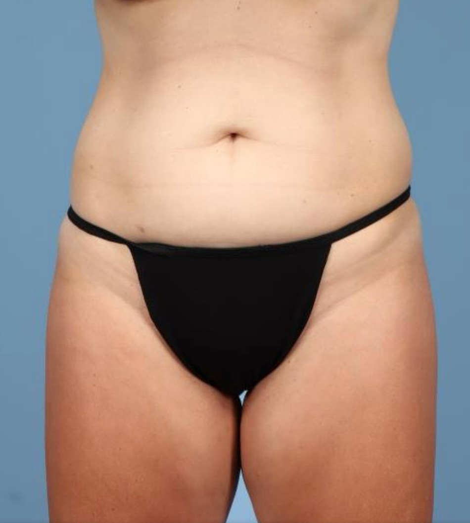 Tummy Tuck Before & After Image