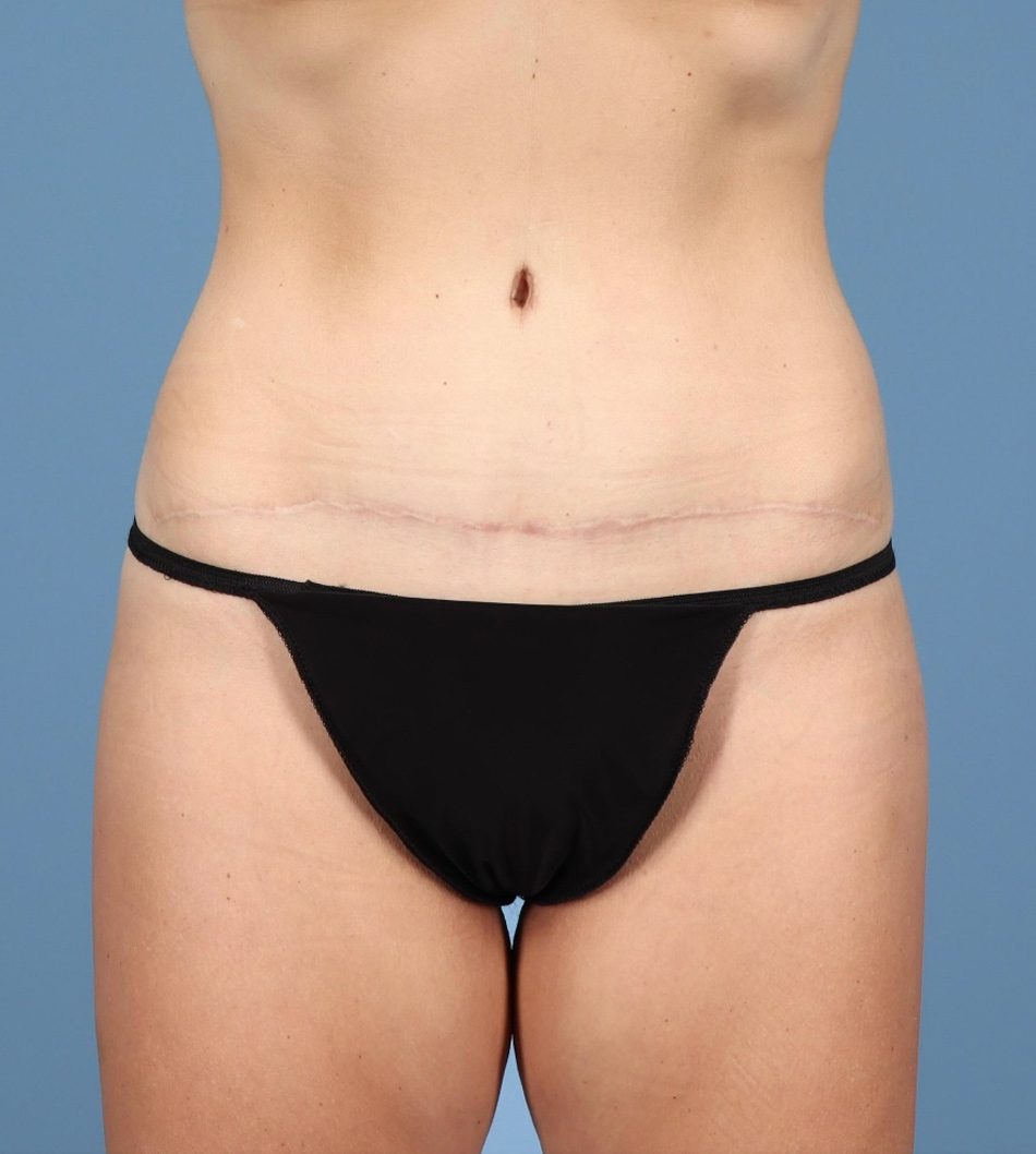 Tummy Tuck Before & After Image