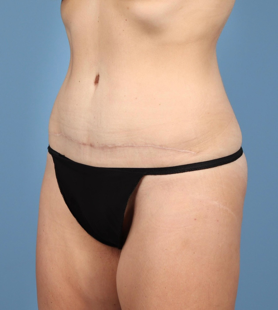 Tummy Tuck Before & After Image