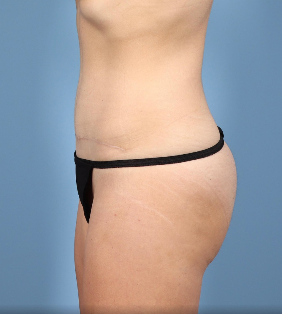 Tummy Tuck Before & After Image