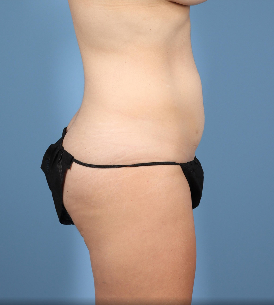 Tummy Tuck Before & After Image