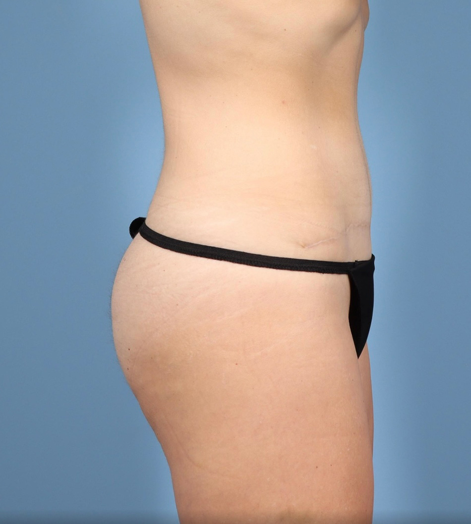 Tummy Tuck Before & After Image