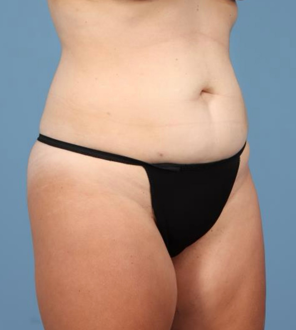 Tummy Tuck Before & After Image