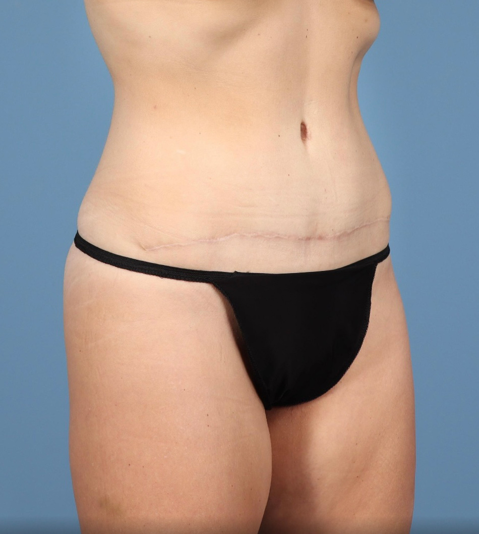 Tummy Tuck Before & After Image