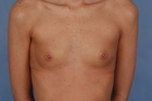 Breast Augmentation Before & After Image