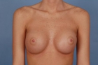 Breast Augmentation Before & After Image