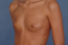 Breast Augmentation Before & After Image