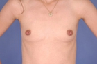 Breast Augmentation Before & After Image