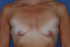 Breast Augmentation Before & After Image